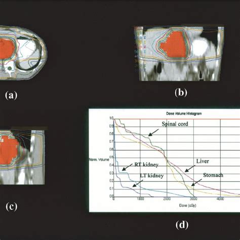 Isodose Curves Of A Three Dimensional Radiotherapy Using Seven Coplanar Download Scientific