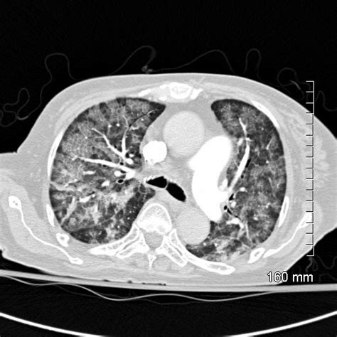 Disease Interlobular Septa Lungs