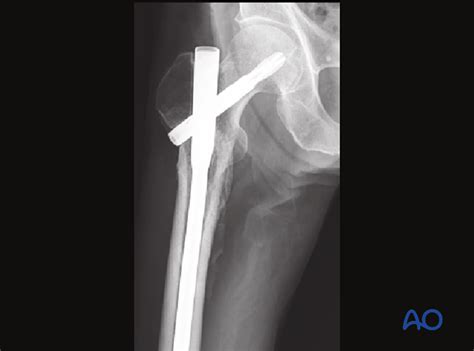 Nailing (short nail) for Intertrochanteric fractures