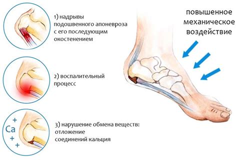 Подошвенный фасциит: симптомы и лечение