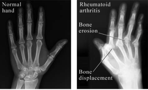 Rheumatology 2 Rheumatoid Arthritis Flashcards Quizlet