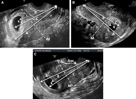 Easy Sonographic Differential Diagnosis Between Intrauterine Pregnancy