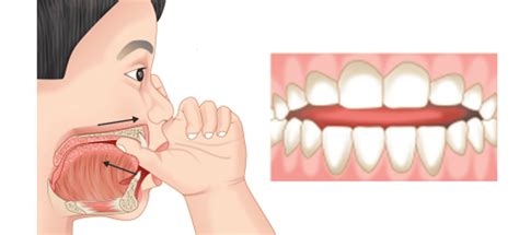 How Can Mewing Fix Overbite Mewing Coach