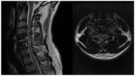 Jcm Free Full Text Degenerative Cervical Myelopathy Clinical