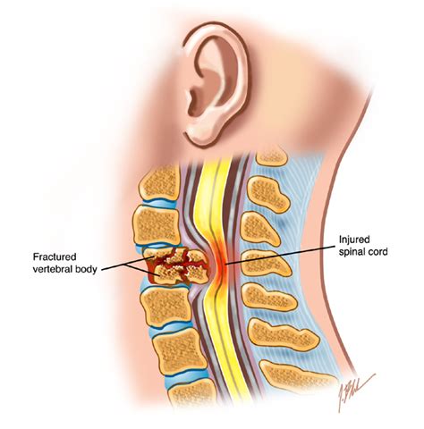 Cervical spinal cord injury treatment