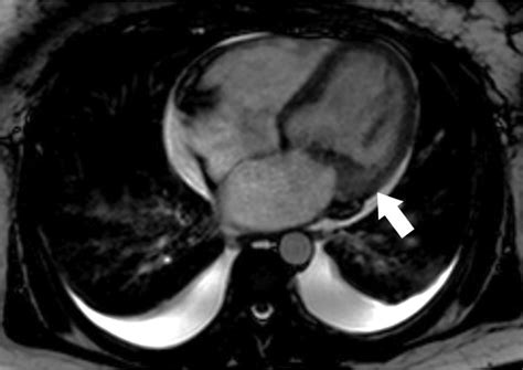 Libman-Sacks endocarditis on CMR. Cine 4-chamber view shows mass-like ...