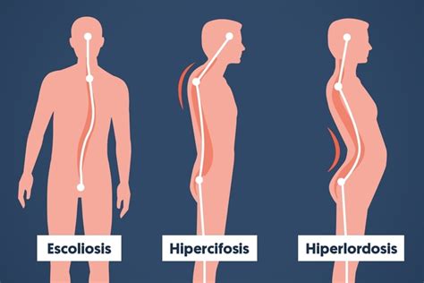 La Hiperlordosis La Regi N Lumbar En Forma De C Neurocirug A De La Torre