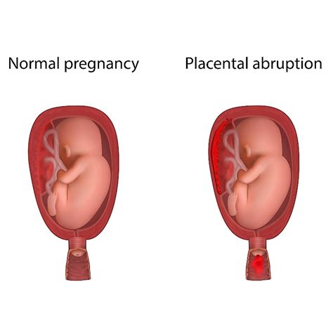 Placental Abruption Symptoms And Risk Factors Cherokee Women S Health