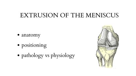 EXTRUSION OF THE MENISCUS Musculoskeletal Ultrasound Examination