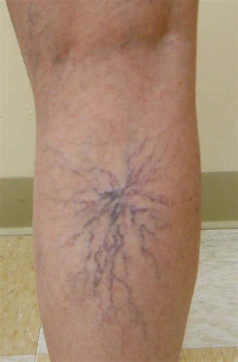 Spider Veins Charlotte | Spider Vein Treatment