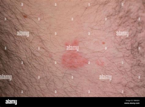 Gürtelrose Herpes zoster Blasen auf Körper Varicella zoster Virus