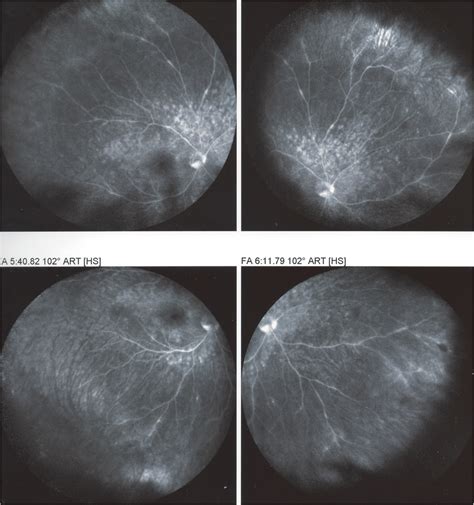 Retinal Vasculitis In Mewds Fa Showing Patchy Hyperfluorescent Area In