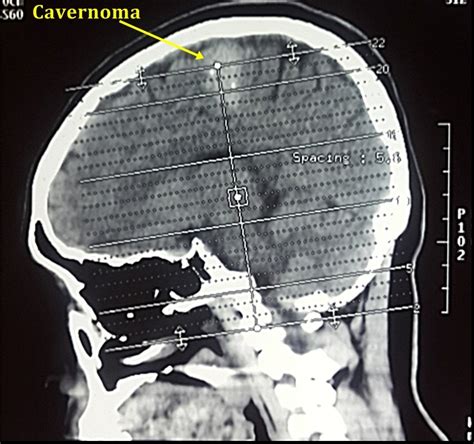 Cavernoma-Image-before-surgery - Brain and Spine Center