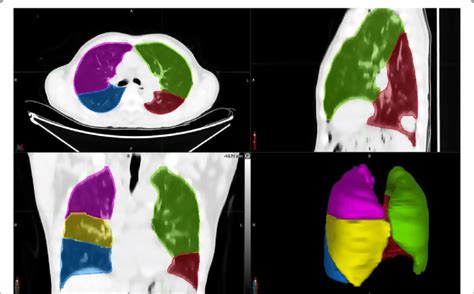 Example Of Lung Lobe Contours From Our 2d 3d Segmentation Network Download Scientific Diagram