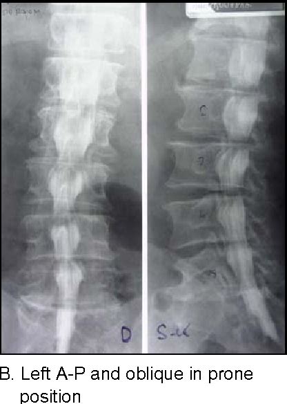 Figure 3 From Lumbar Myelography Enhanced With Ion Free Contrast Medium