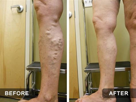 Vein Treatment Center Tampa Bay Fl Vein Specialists Of Tampa Fl