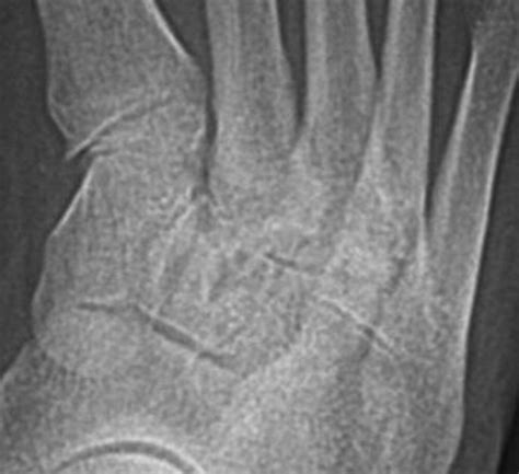 Influence Of A Metatarsus Adductus Foot Type On Plantar Pressures