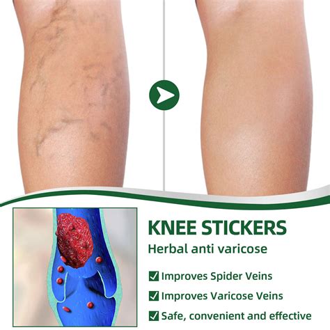 South Moon Venous Repair Solution Relieves Leg Varicose Pain Earthworm