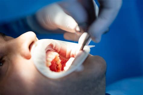 Tooth Socket Preservation Techniques After Tooth Extraction