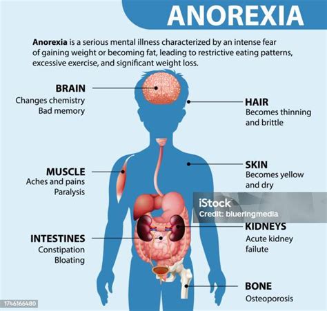 Effects Of Anorexia On Male Anatomy Stock Illustration Download Image