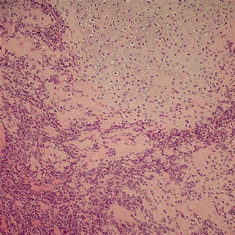 Nasal Melanoma Showing Round Nuclei And Prominent Nucleoli Melanin