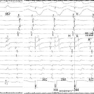 Ablation Of Atypical Atrioventricular Nodal Reentrant Tachycardia A