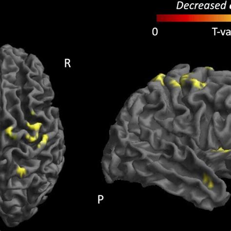 Functional Connectivity Of The Primary Motor Cortex Is Reduced In