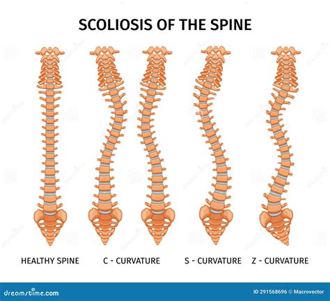 Infografía De Anatomía Por Escoliosis Espina Dorsal Ilustración del