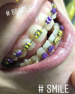 Boy Yellow Purple Braces Braces Explained