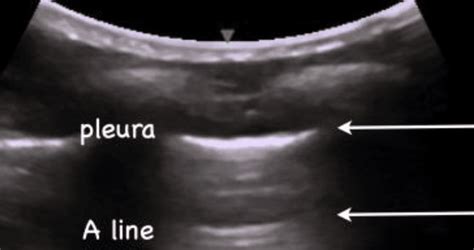 POCUS Made Easy Lung LITFL Ultrasound Library