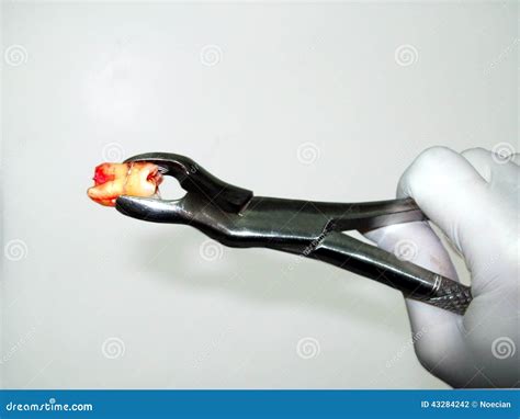 Molar Extraction. Tooth Loss Anatomical Structure. 3d Medical Illustration. | CartoonDealer.com ...