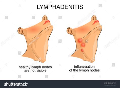 Illustration Inflammation Submandibular Lymph Nodes Immagine