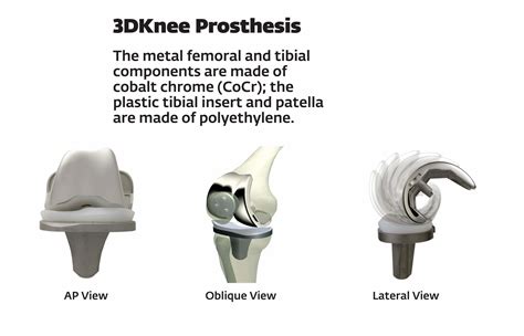 New Knee Replacement Options