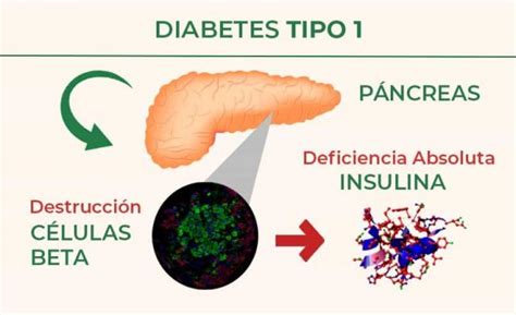 Diabetes Tipo 1 Qué Es Síntomas Causas Tratamiento Natural Nuevas