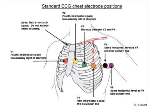 For Recording A 12 Lead Ecg The Correct Anatomical Positions For The