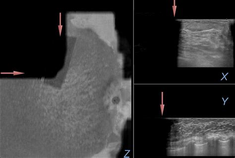 Three Dimensional Automated Breast US Facts And Artifacts RadioGraphics