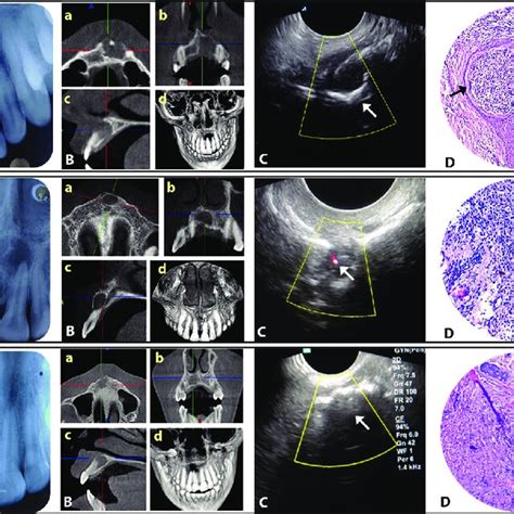 (I) Periapical cyst: (A) IOPA radiograph, (B) (a-d) CBCT views (c ...