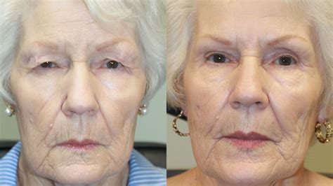 Blepharoplasty Archives Eye Center South