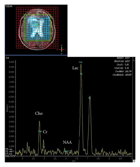 Proton Magnetic Resonance Spectroscopy H Mrs Analysis Of A Voxel Of