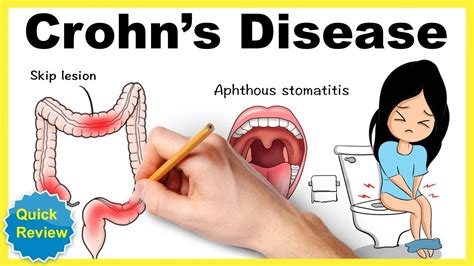 Crohns Disease Causes Symptoms Diagnosis And Treatment