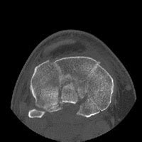 Orthopaedics Mcqs Postgraduation entrance preparation: 89 - Bumper fracture