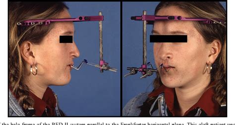 Figure 1 from Complications in maxillary distraction using the RED II ...