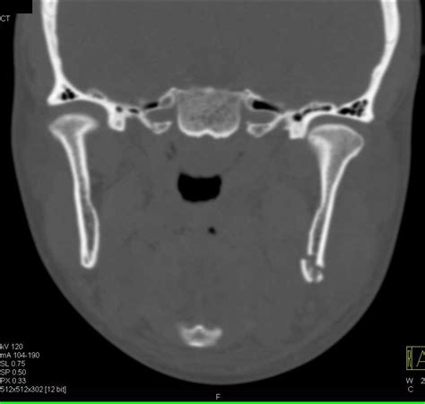 Mandibular Fracture With Repair Trauma Case Studies Ctisus Ct Scanning