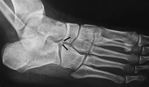 Os Calcaneus Secundarius Mimicking Fracture BMJ Case Reports