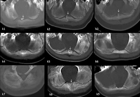 Figure 1 From The Ossification Process Of The Occipital Bone And Normal Variants Evaluation By