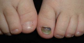 VIRTUAL GRAND ROUNDS IN DERMATOLOGY 2 0 3 Yo With Nail Dystrophy