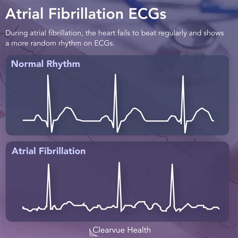 AFib EKG Vs Normal