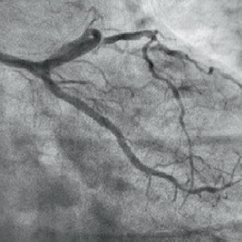 (a) Post-PCI image of RCA showing coronary spasm just proximal to RCA ...