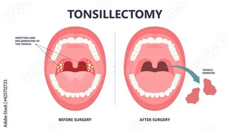 Tonsil Stones Crypts Viral Virus Gland Strep Throat Sore Enlarged Lymph