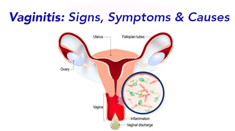 Vaginitis: Signs, Symptoms, & Causes to Know - WomenWorking